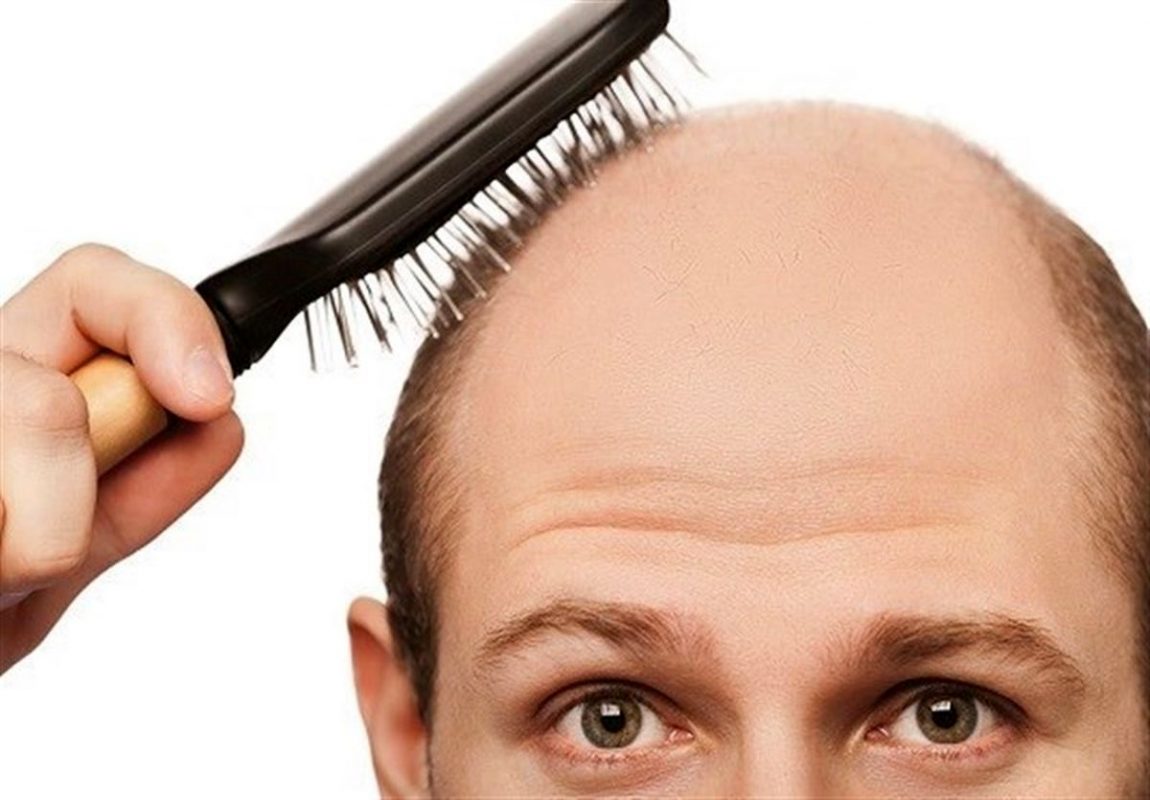 ما سبب تساقط الشعر عند الرجال؟